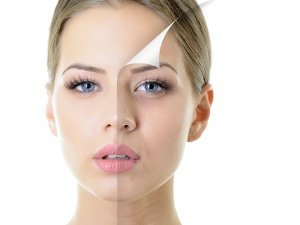 Chemický peeling obličeje pro ženy Chemický peeling obličeje pro ženy