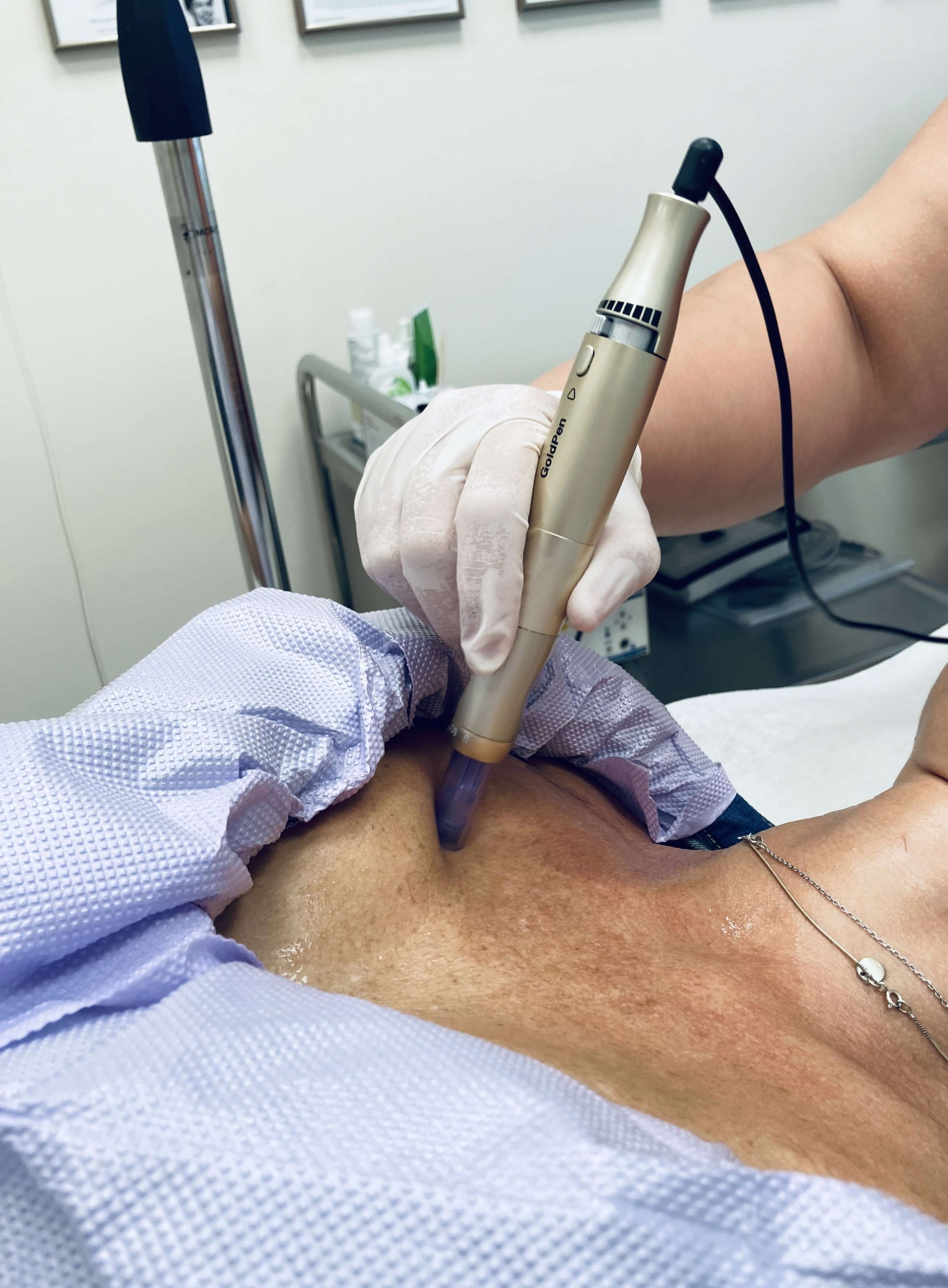Hydratace pleti pomocí DermaPen Hydratace pleti pomocí DermaPen