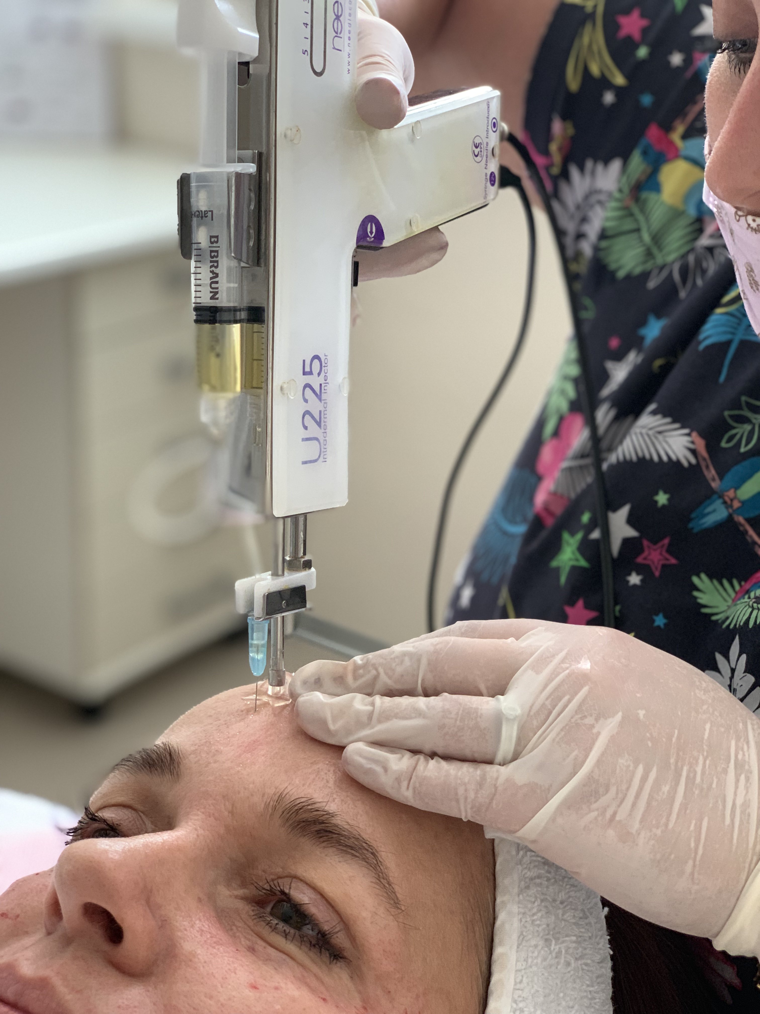 Plazma lifting & Brigthening - výživa, projasnění, depigmentace