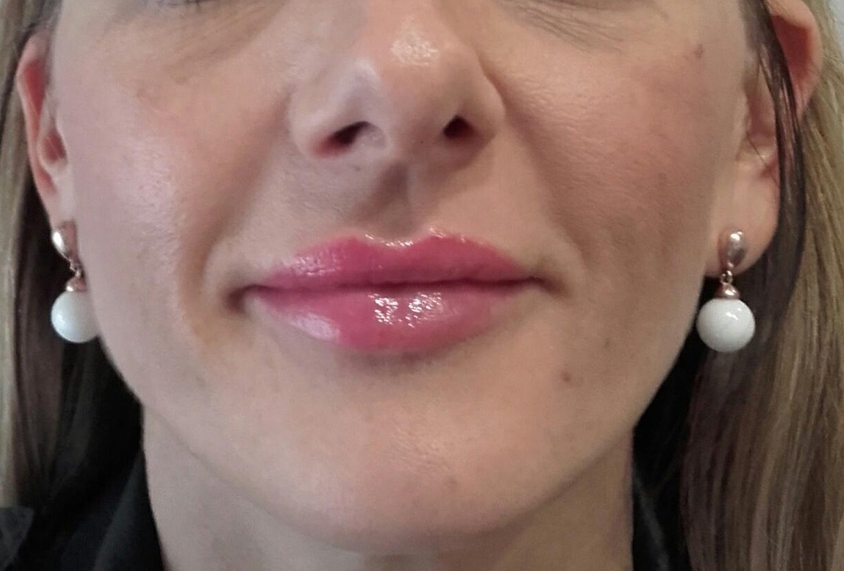 Po výplni kyselinou hyaluronovou