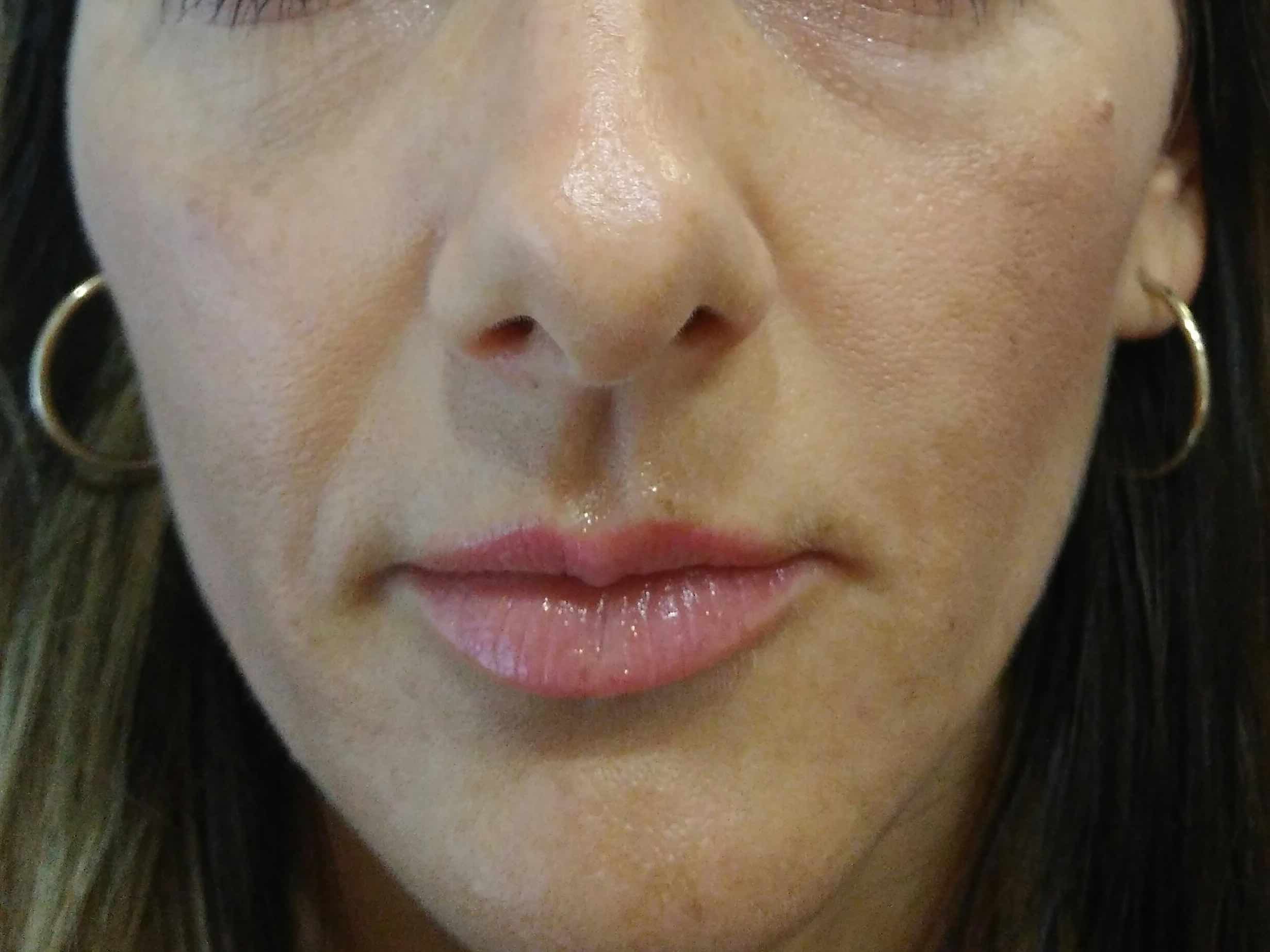 Před výplní kyselinou hyaluronovou